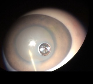 DepressurEyZ device shown implanted in cornea